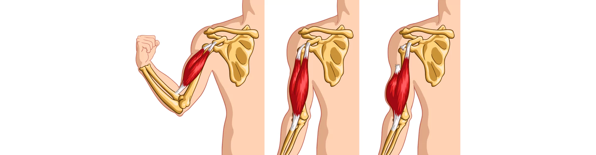 Strappi-muscolari-e-mal-di-schiena-come-evitarli-durante-lallenamento